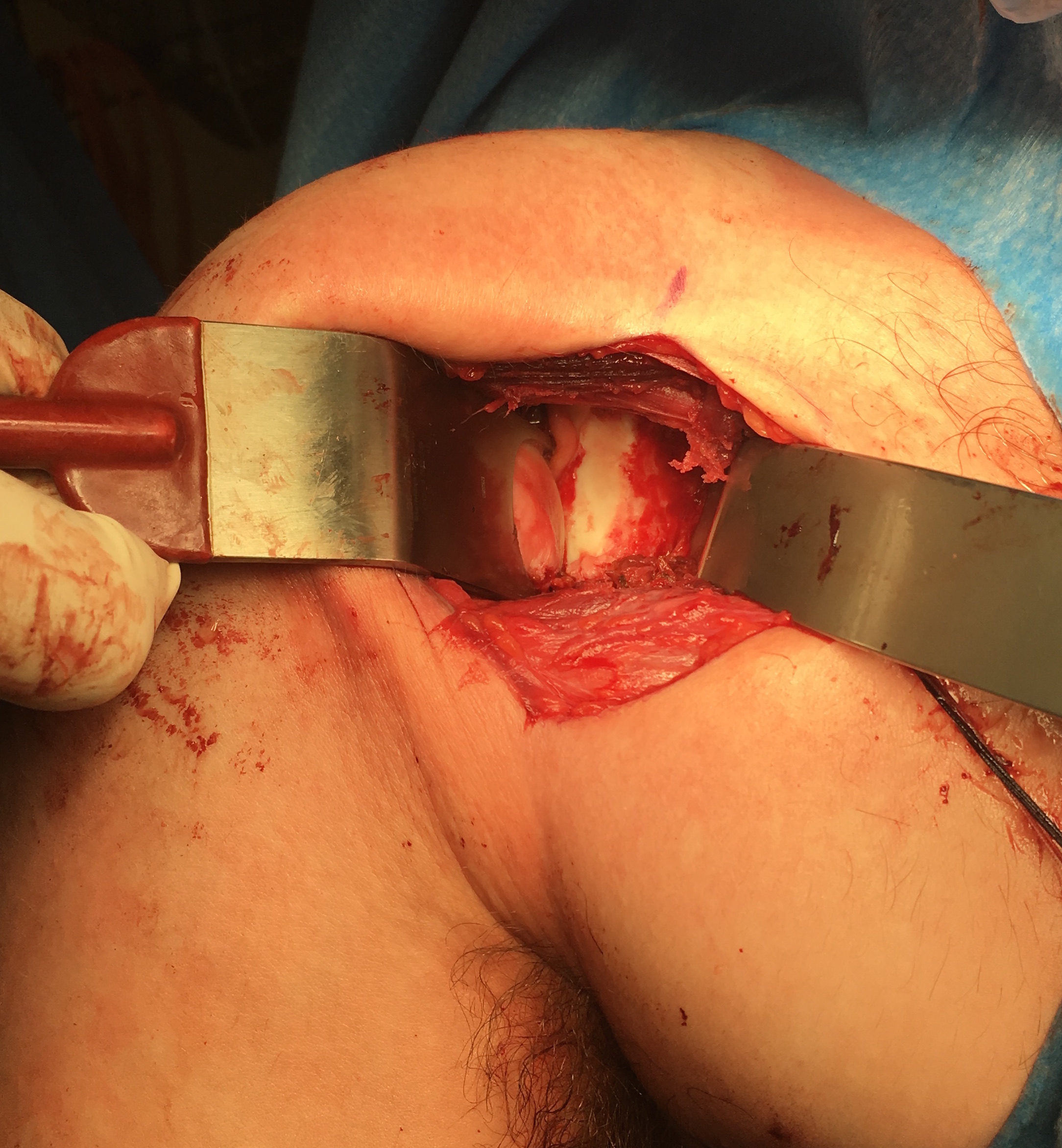 Distal Tibial Allograft